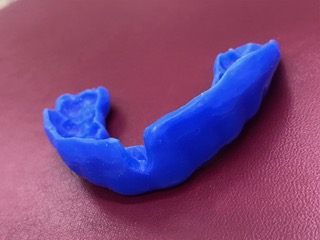 S大学女子ラクロス部マウスピース作成事例